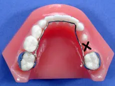 Orthodontic space maintainer Orthodontic space maintainer